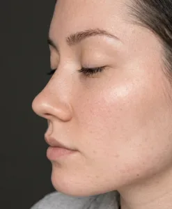 Post acne 2 después