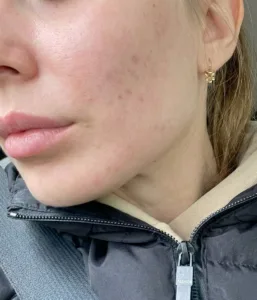 Post acne 3 despues