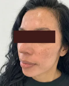 manchas nuevo 1 despues
