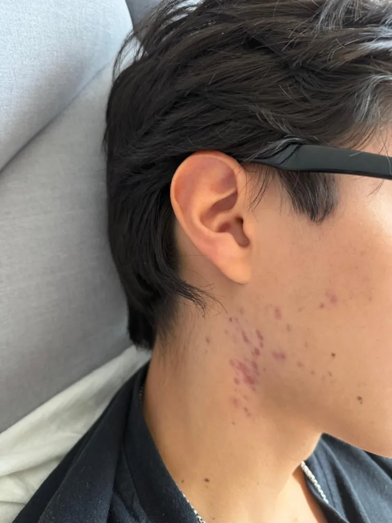post acne 1 antes