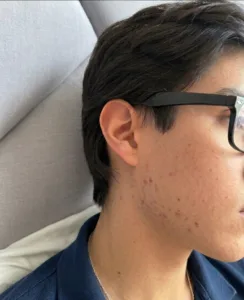 post acne 1 despues